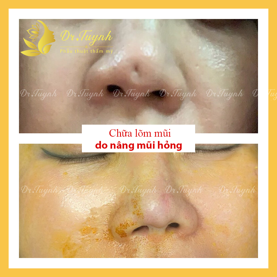 Nâng mũi rồi muốn tháo, những điểm quan trọng chú ý