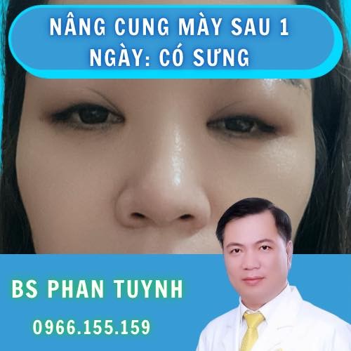 Nâng cung mày xong là phải có sưng