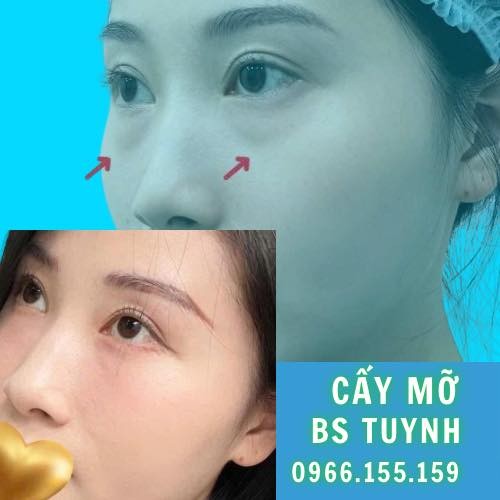 Làm đầy hố lệ bằng mỡ hay HA