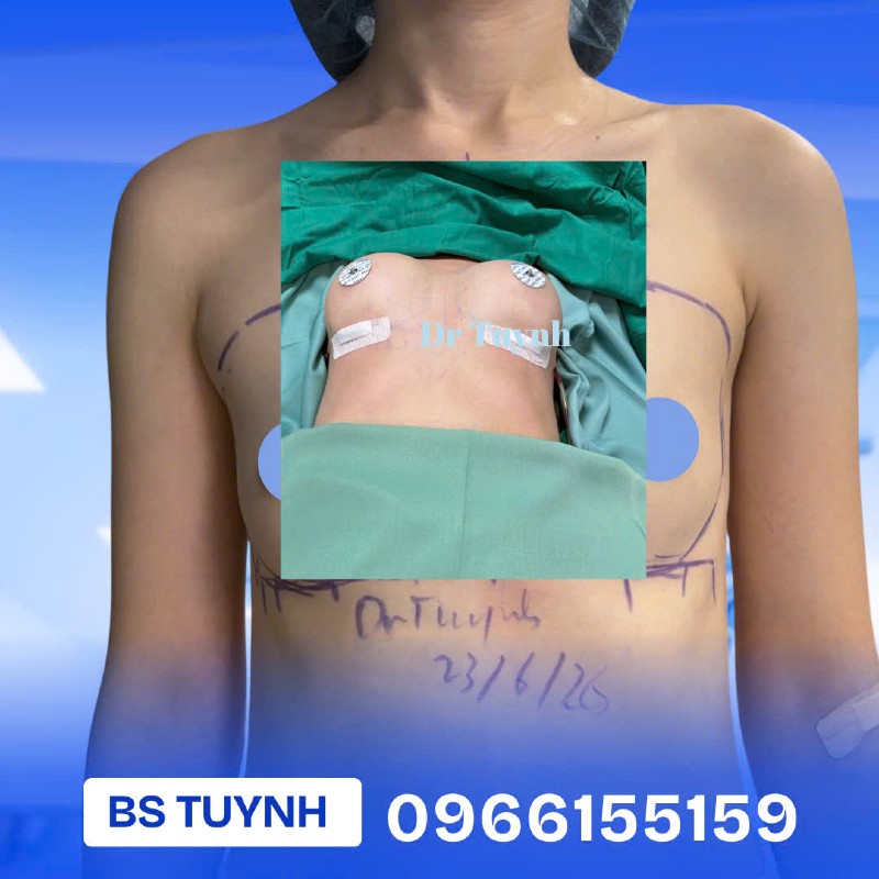 Cấy Mỡ Ngực b