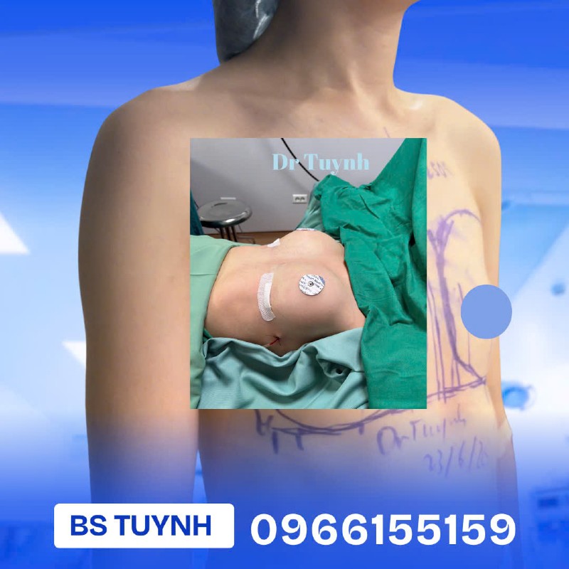 Phẫu thuật nâng ngực a