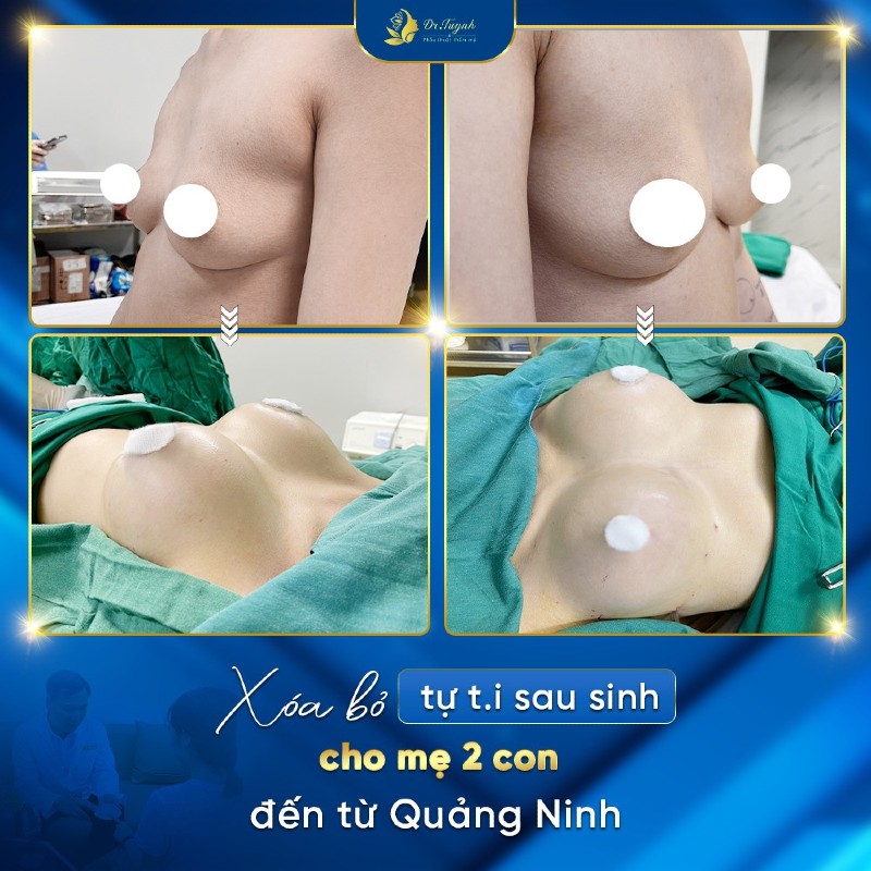 Phẫu thuật nâng ngực