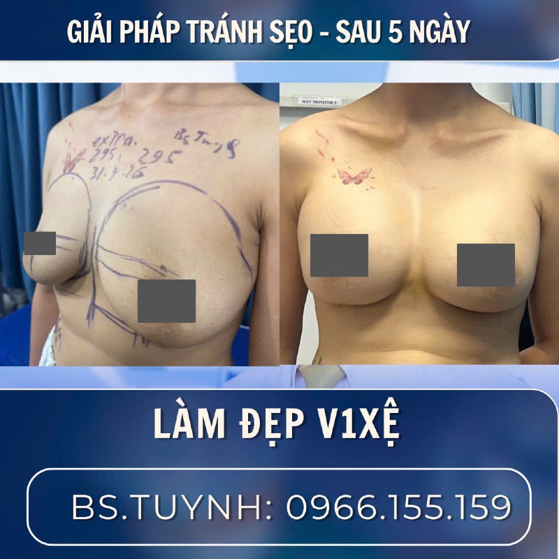 Treo ngực sa trễ-1