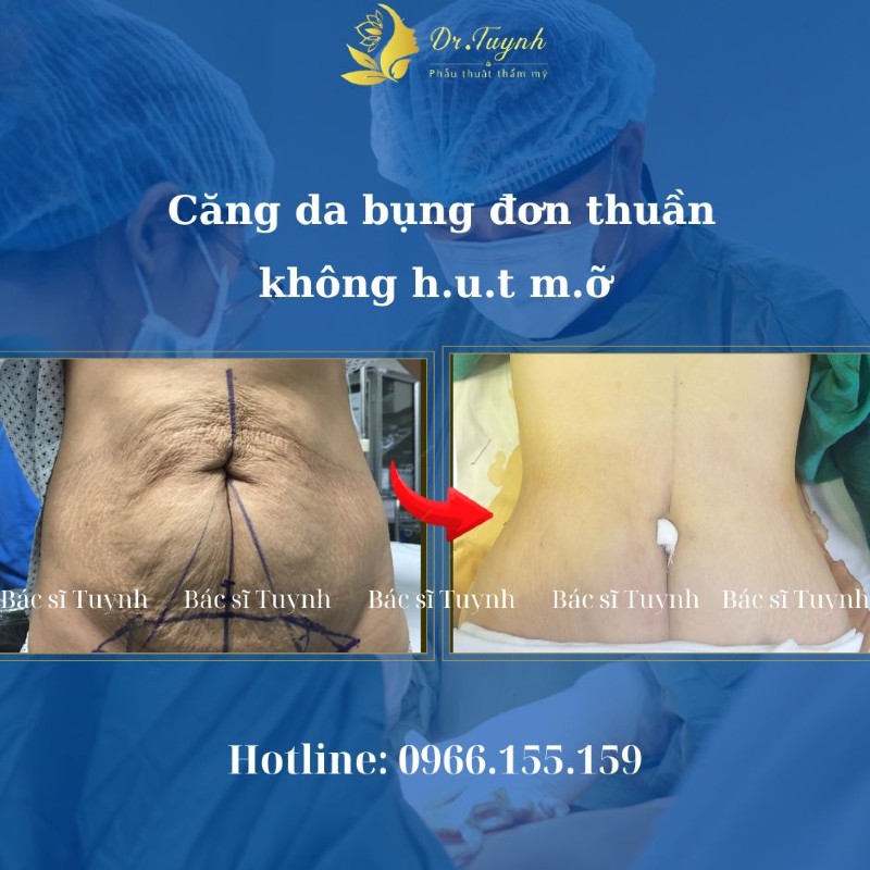 căng da bụng mini