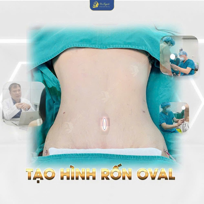 căng da rốn-1