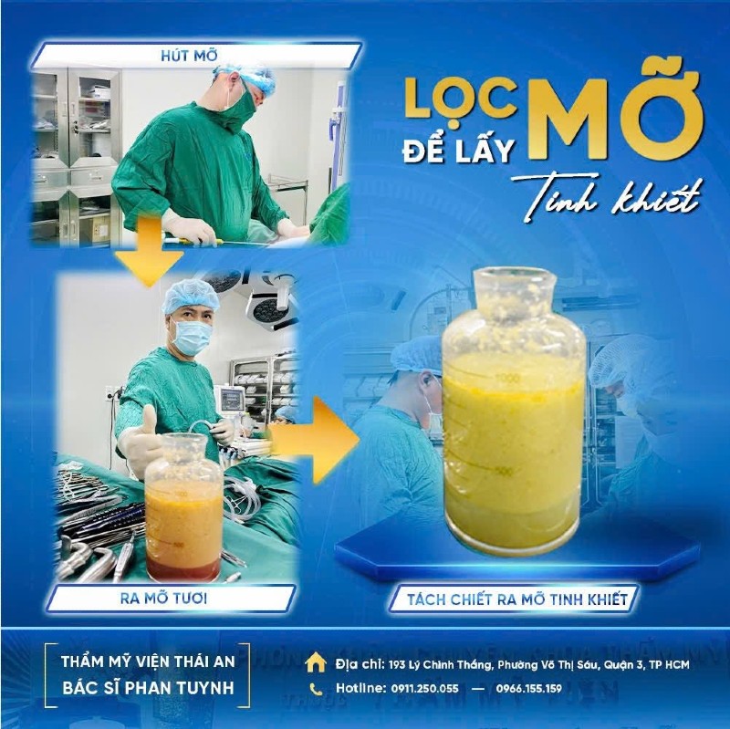 cấy mỡ mông a