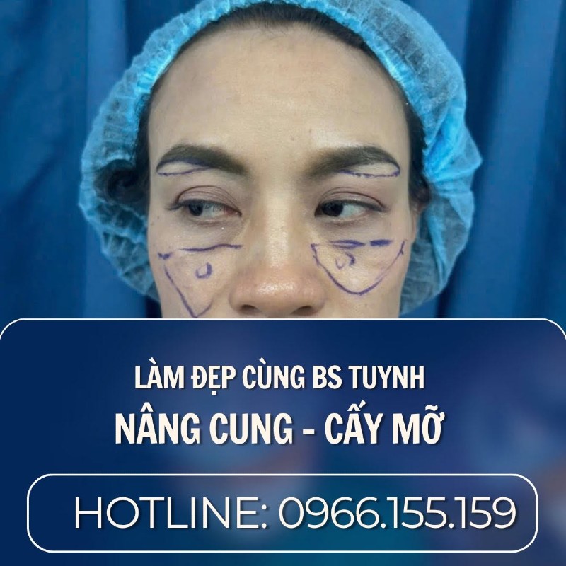 cấy mỡ mặt b