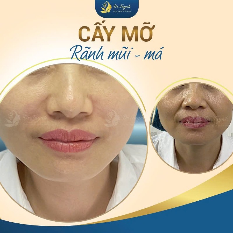 cấy mỡ mặt e