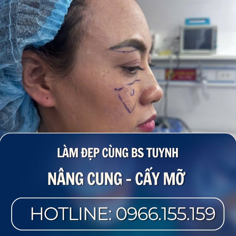 cấy mỡ mặtd a