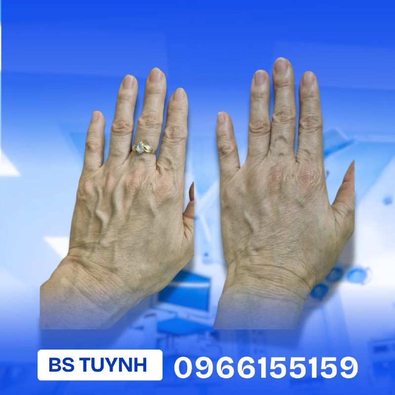 cấy mỡ mu bàn tay a