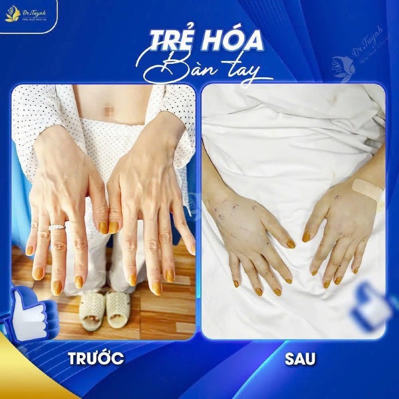 cấy mỡ mu bàn tay b