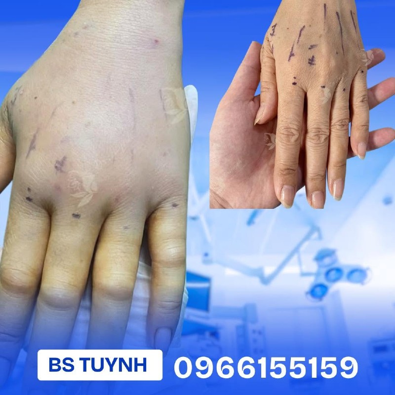 cấy mỡ mu bàn tay