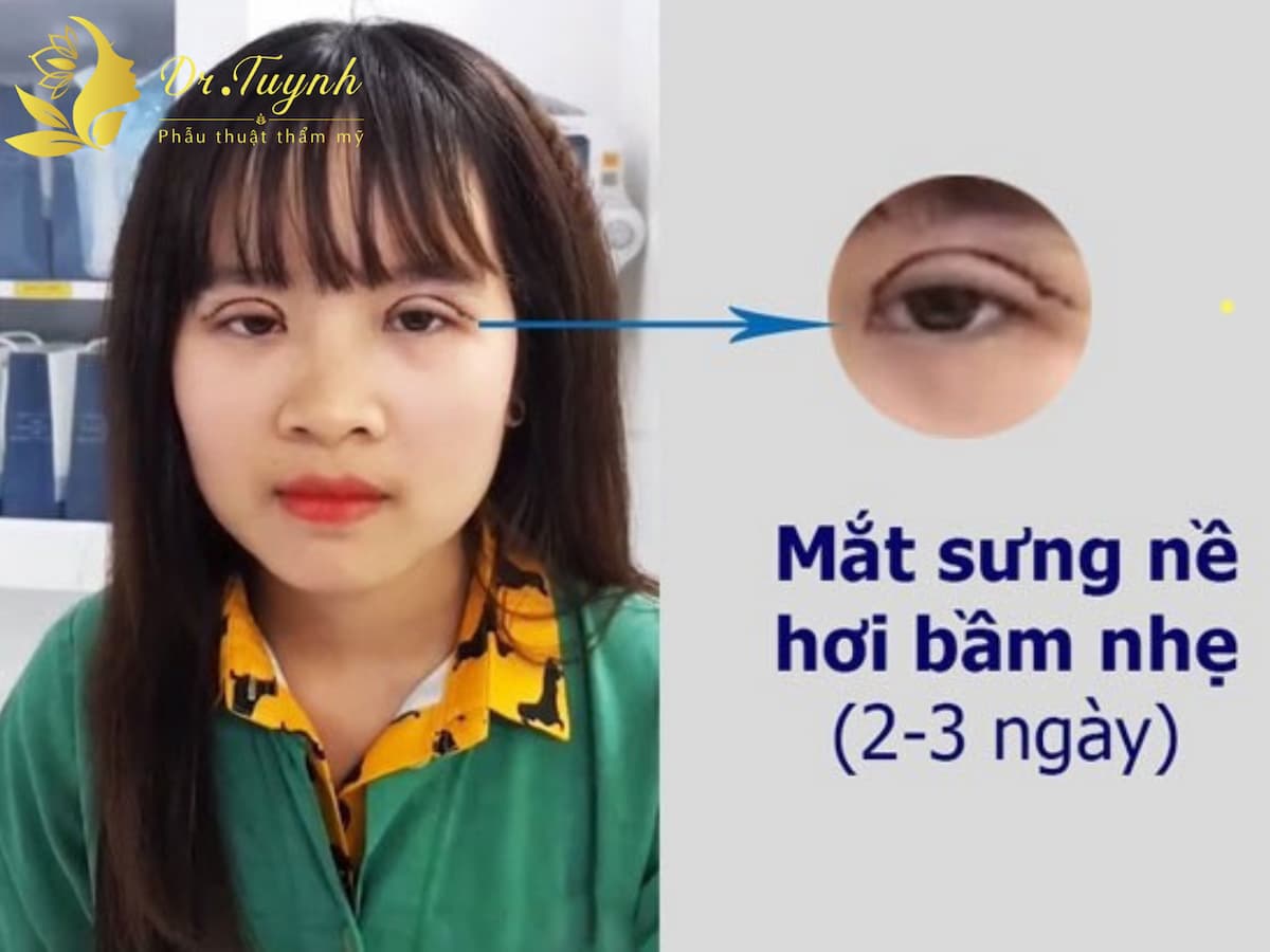 cac-trieu-chung-sau-cat-mi-khong-dang-ke