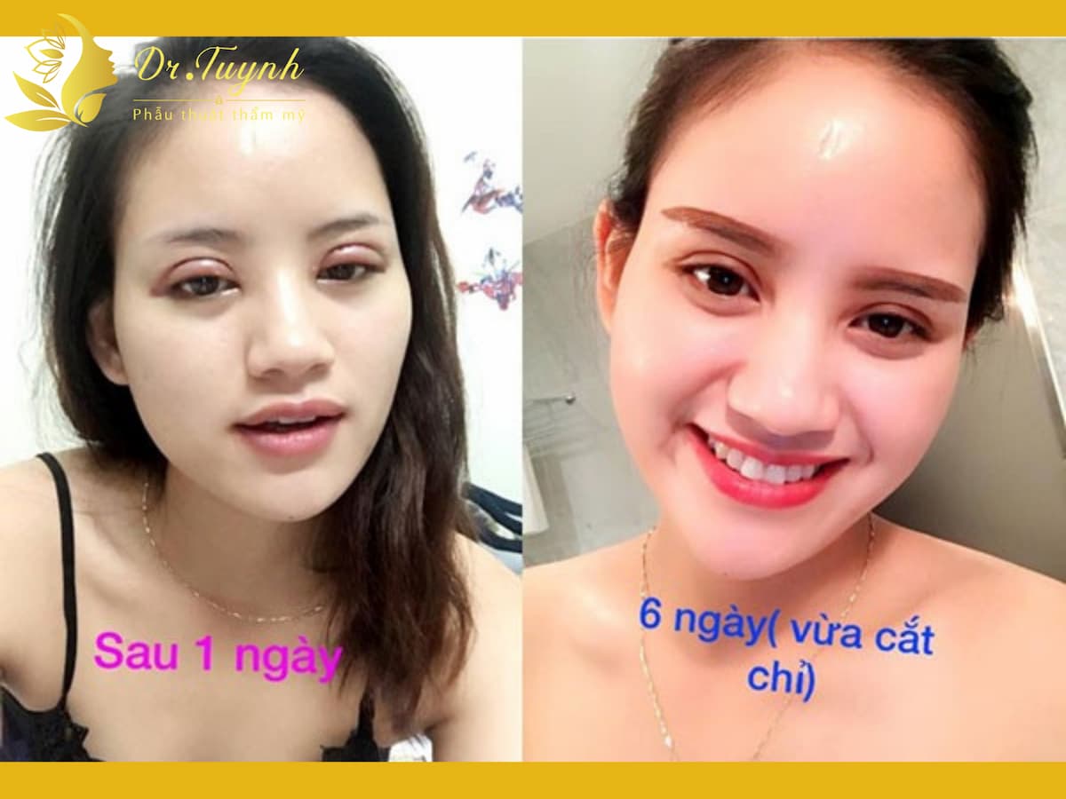 cat-mi-khong-gay-dau-don