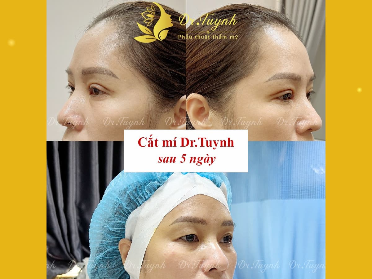 cat-mi-mini-deep-co-duoc-vinh-vien-khong-7