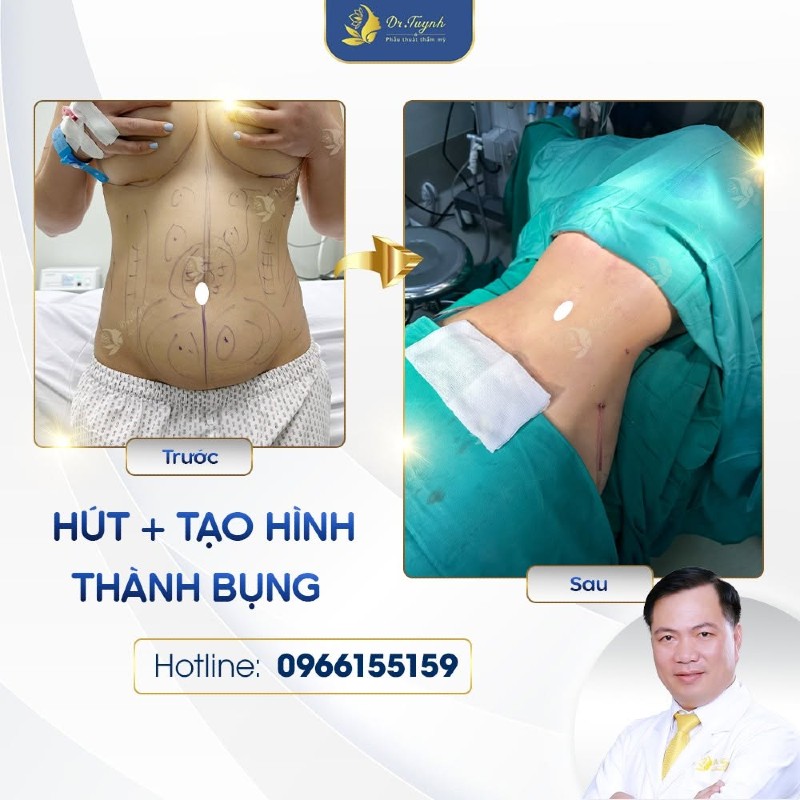 chăm sóc sau tạo hình thành bụng a