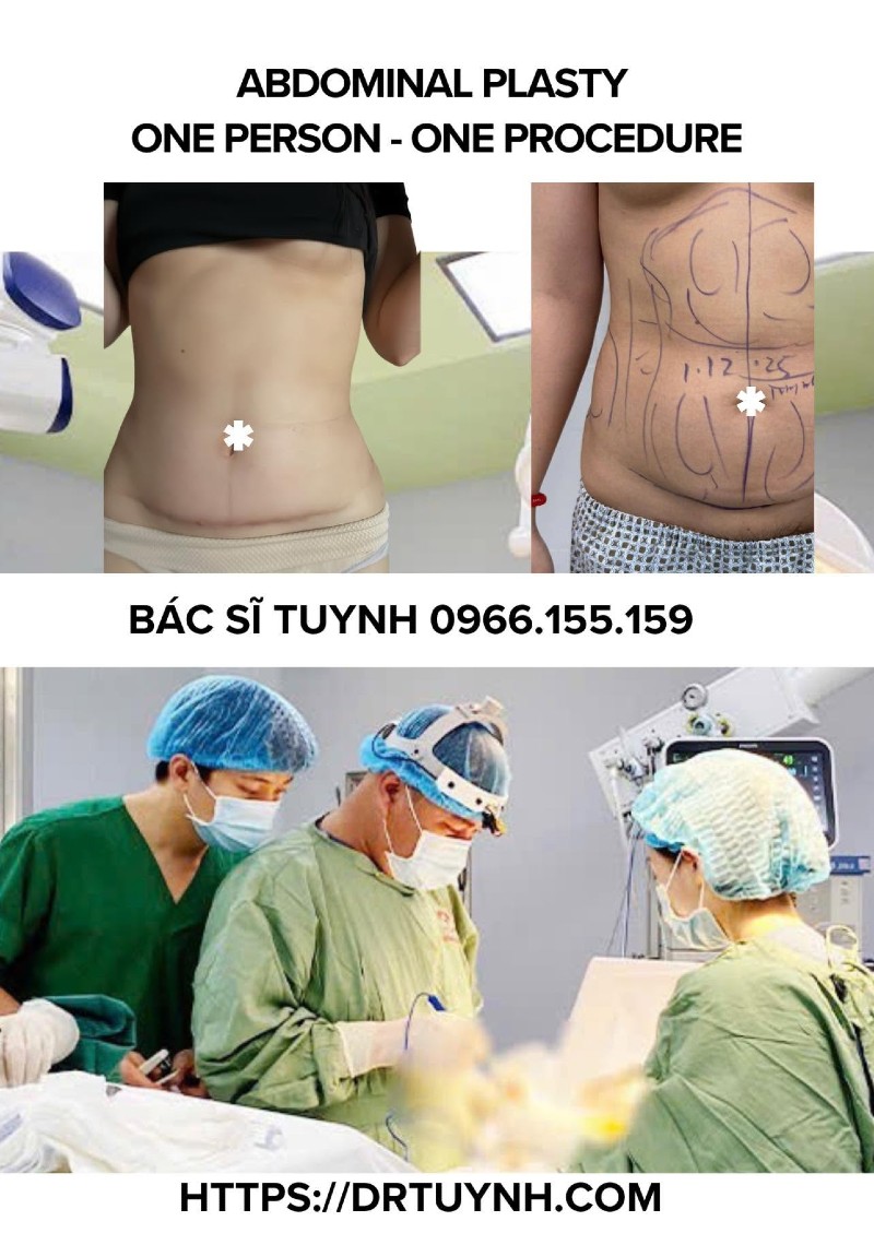 chăm sóc sau tạo hình thành bụng
