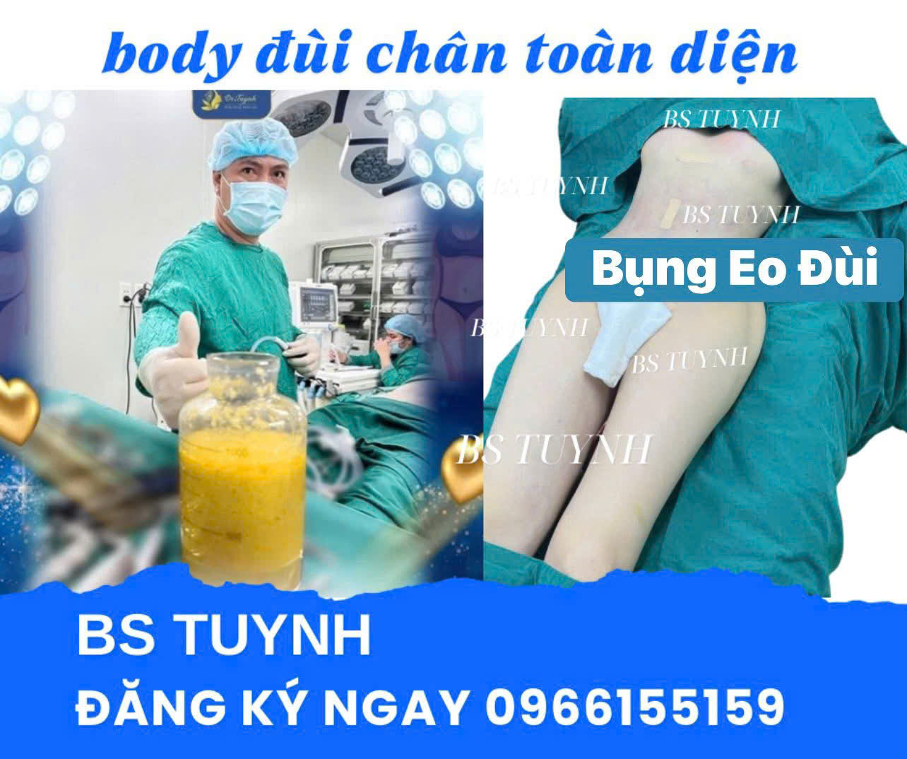 hút mỡ đùi