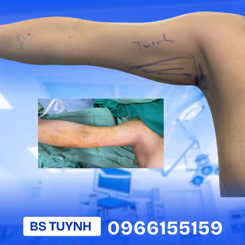 hút mỡ bắp tay (1)