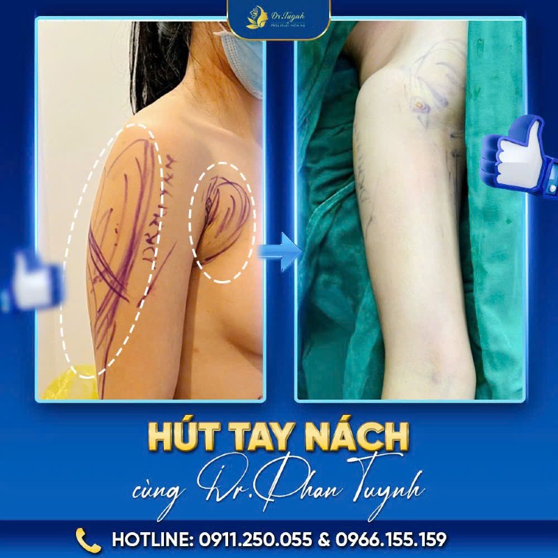 hút mỡ bắp tay 