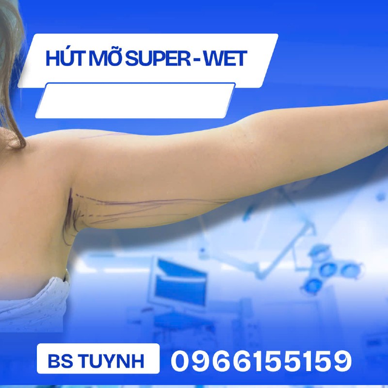 hút mỡ bắp tay 1