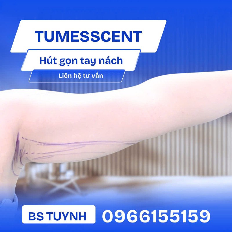 hút mỡ bắp tay 2