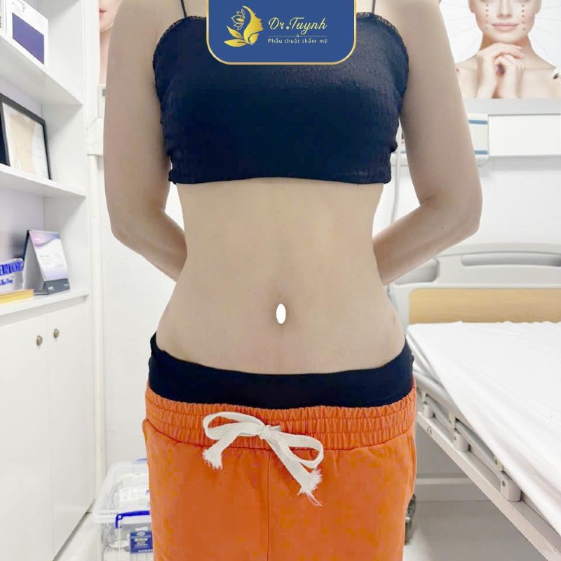 hút mỡ bụng abcd