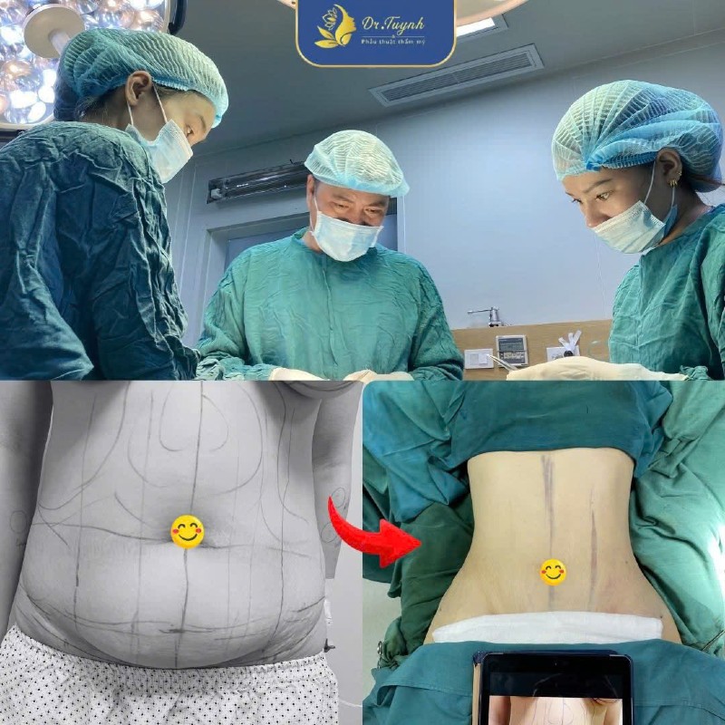 hút mỡ bụng abcde