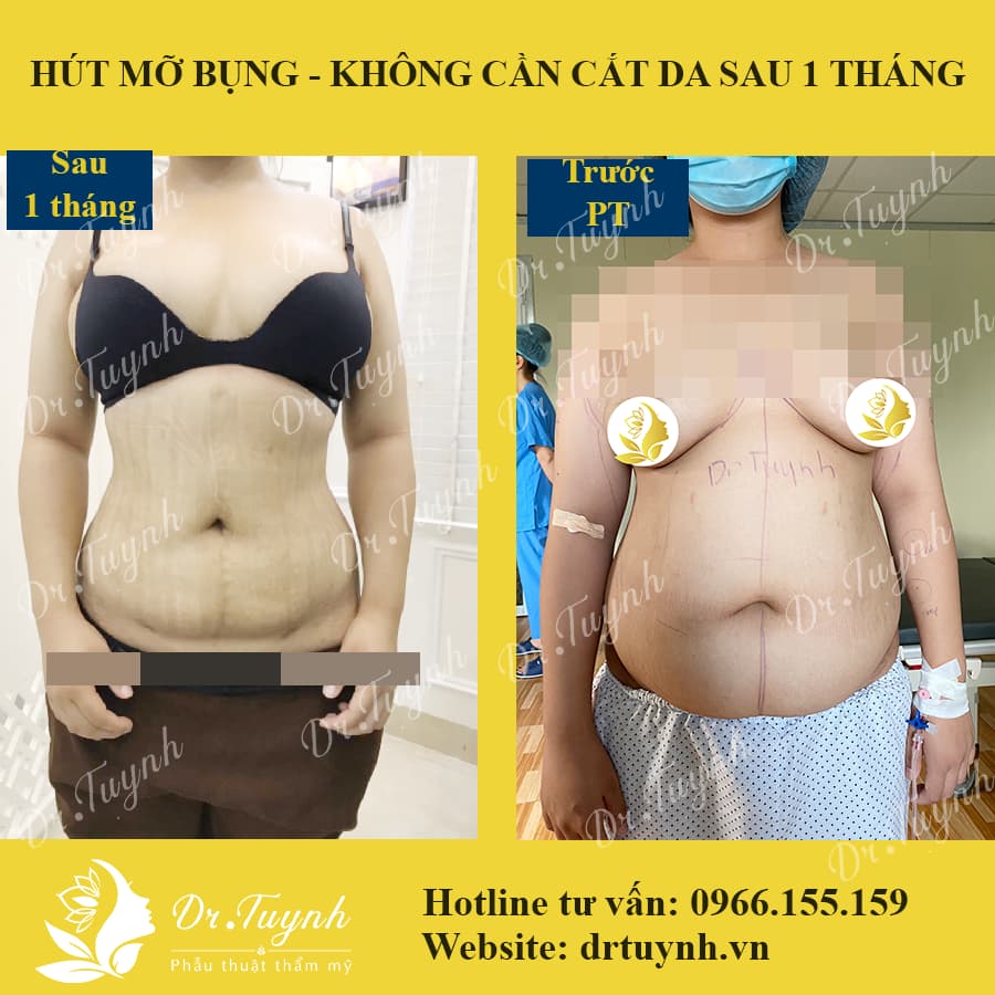 hut-mo-bung-khong-cang-da-1