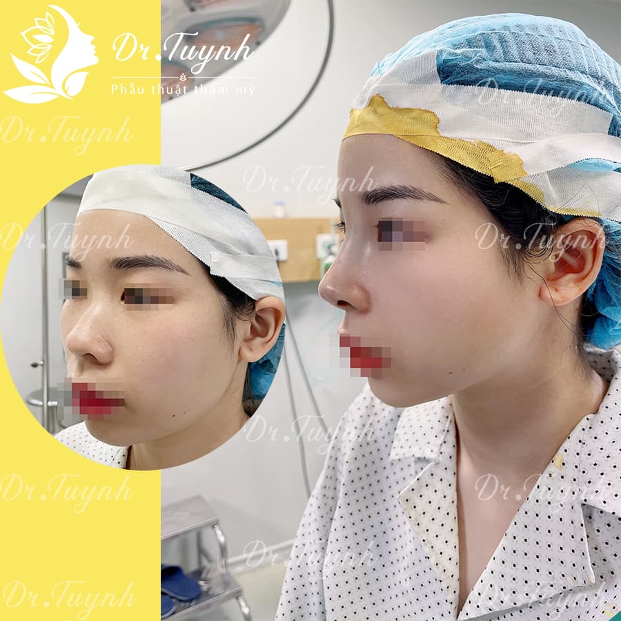 nang-mui-dr-tuynh