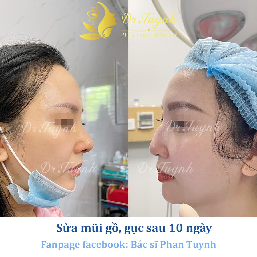 sua-mui-go-guc