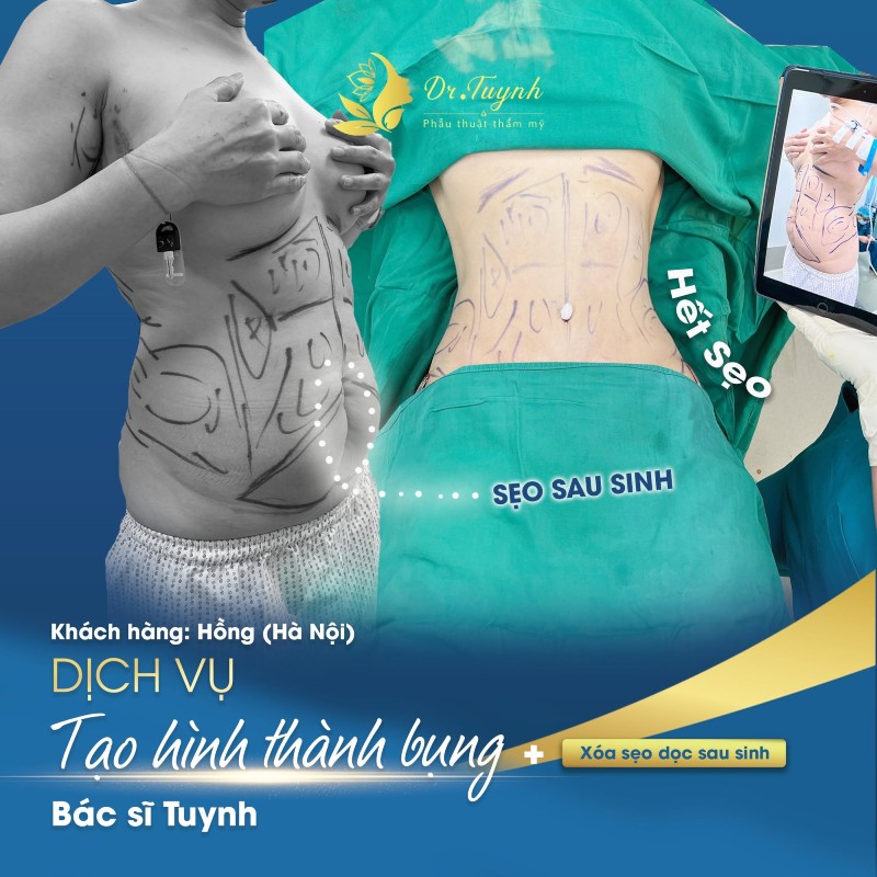 tạo hình thành bụng mini a