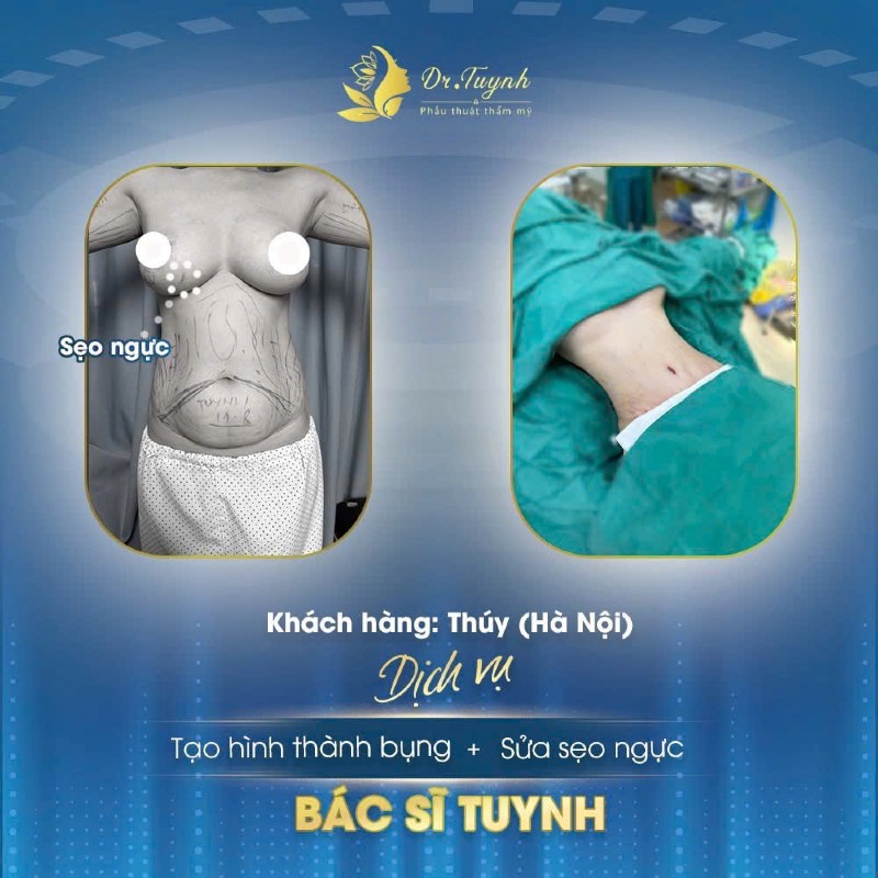 tạo hình thành bụng2