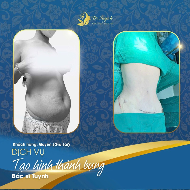 tạo hình thành bụng3