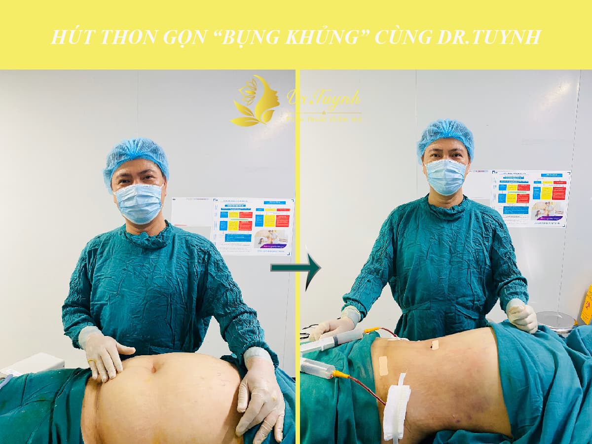 tao-dang-body-bang-hut-mo-1