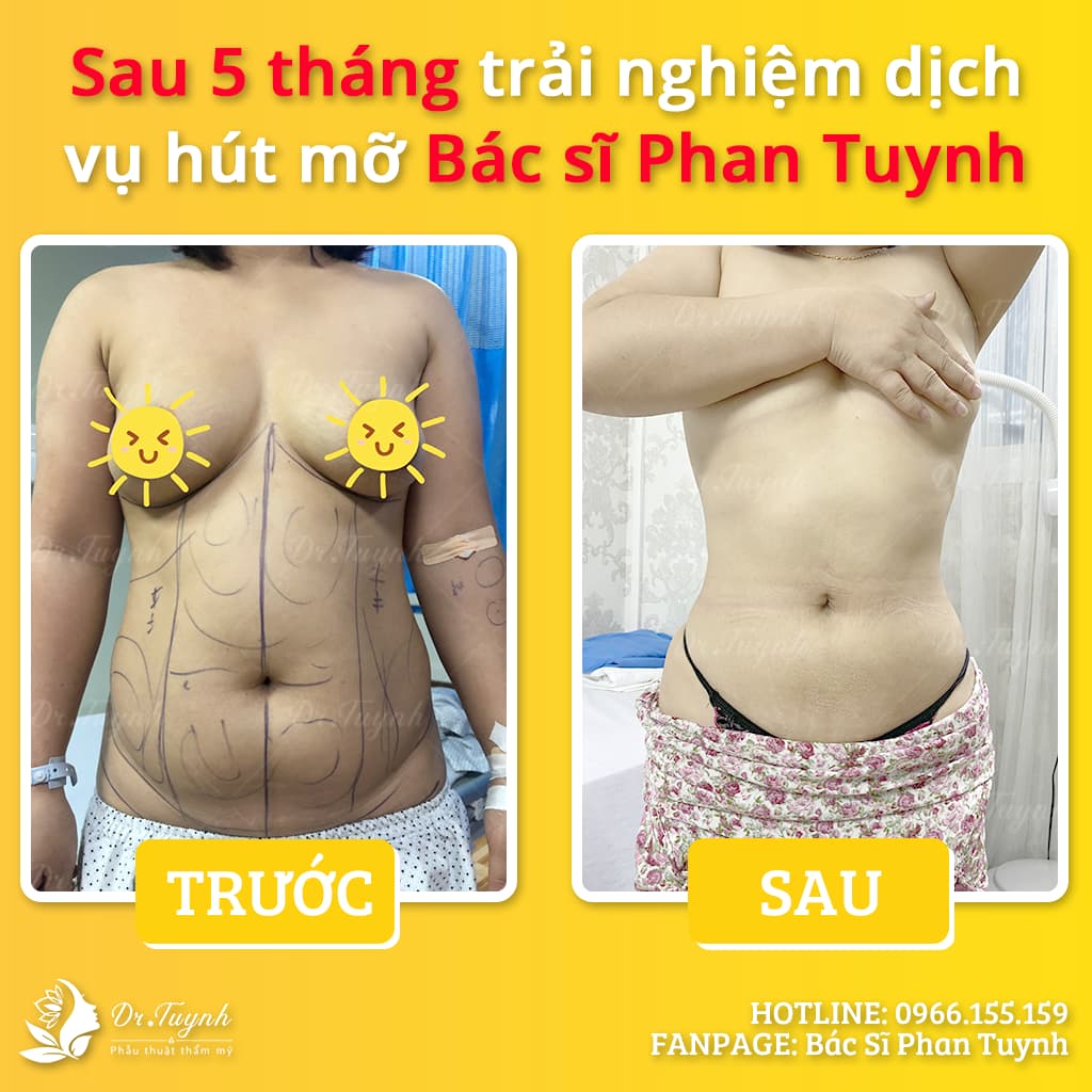 tao-dang-body-bang-hut-mo-2