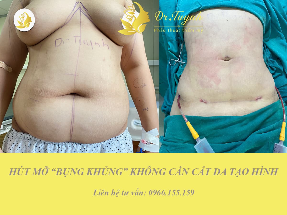 tao-dang-body-bang-hut-mo-3