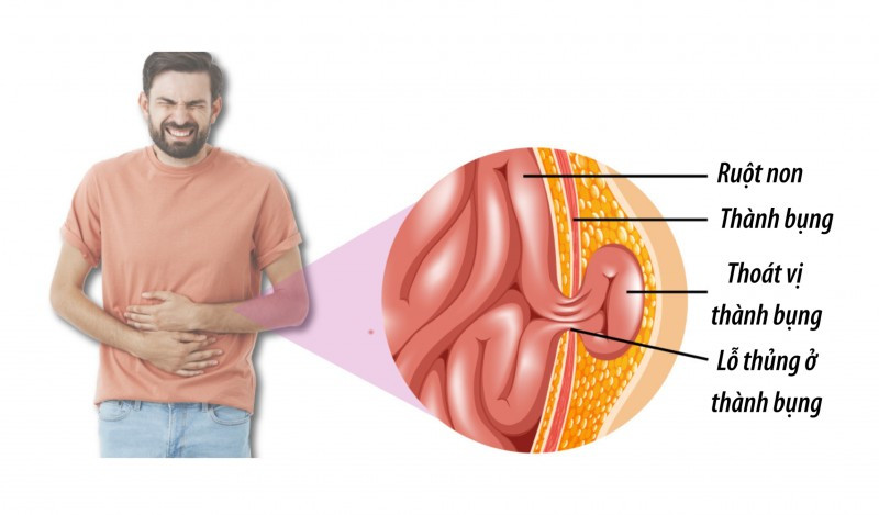 Thoát Vị Thành Bụng