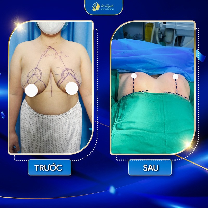 treo nguc sa tre 1