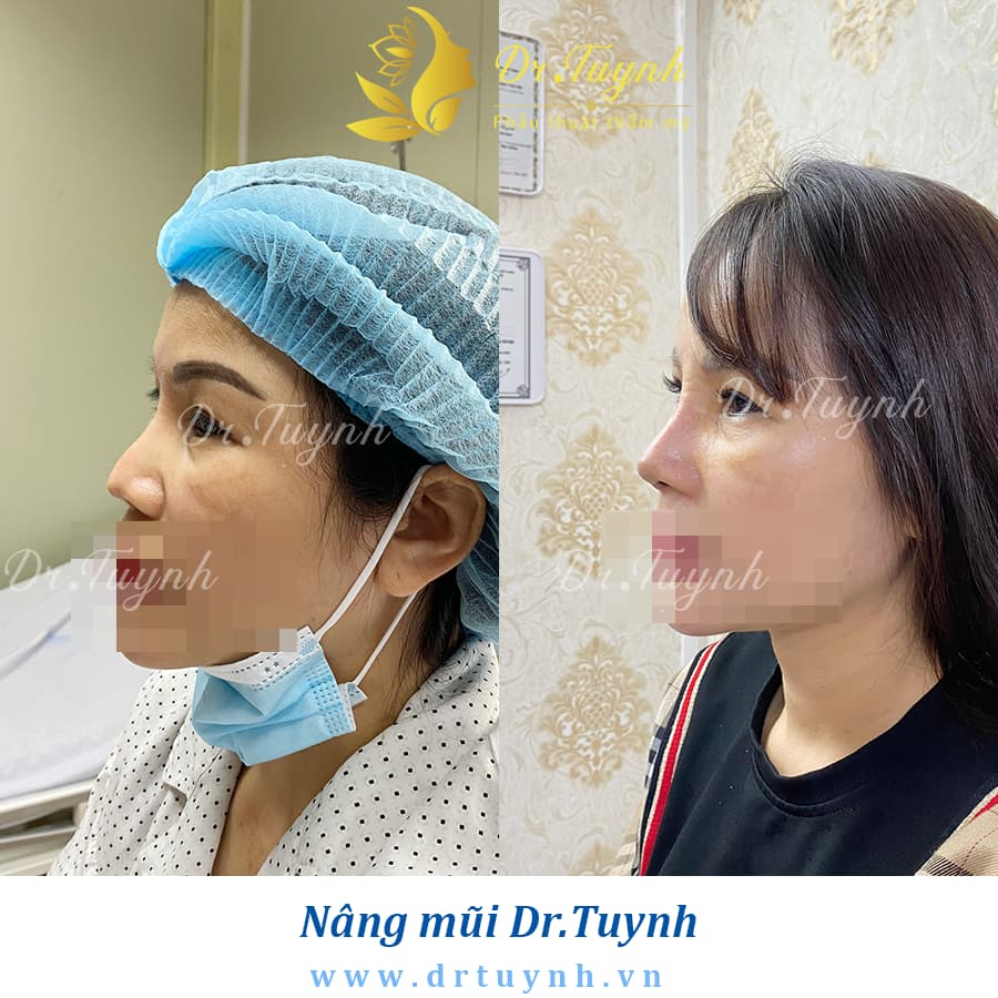MỘT SỐ BIẾN CHỨNG THẨM MỸ MŨI BẠN NÊN BIẾT TRƯỚC KHI NÂNG MŨI (Những điều cần biết khi nâng mũi - phần 5)