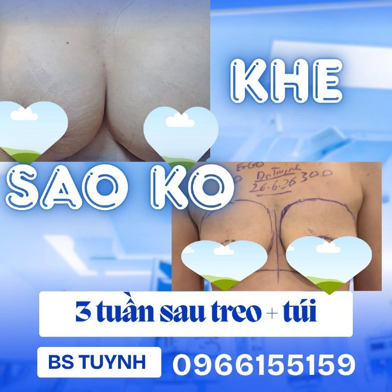 Nâng ngực chảy xệ và những điều cần biết (1)