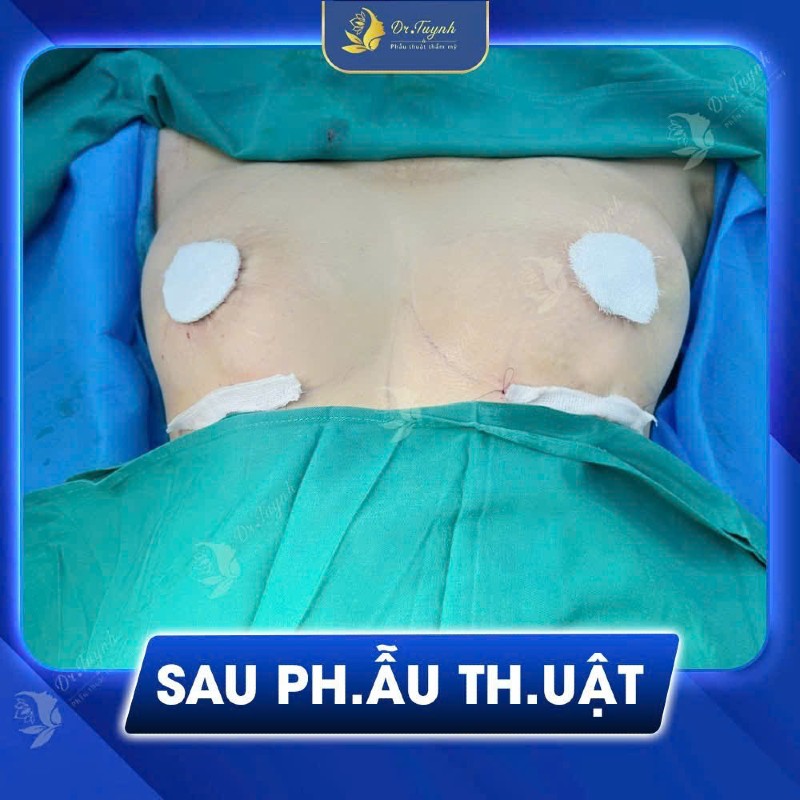 Nâng ngực chảy xệ và những điều cần biết (3)