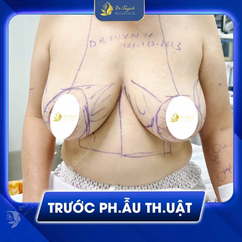 Nâng ngực chảy xệ và những điều cần biết a