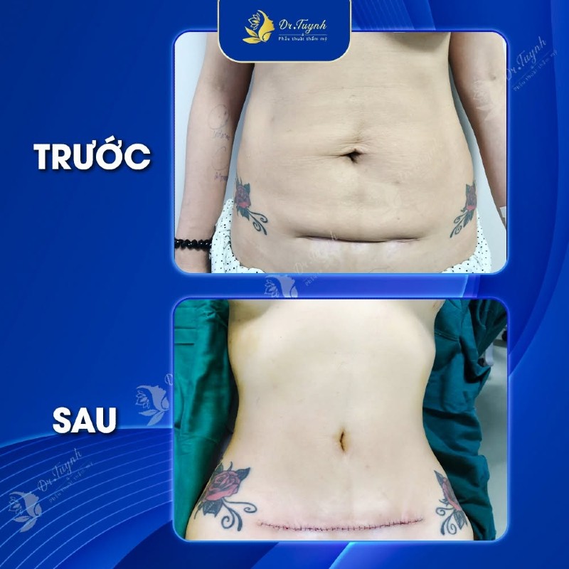 Quy trình phẫu thuật tạo hình thành bụng (2)