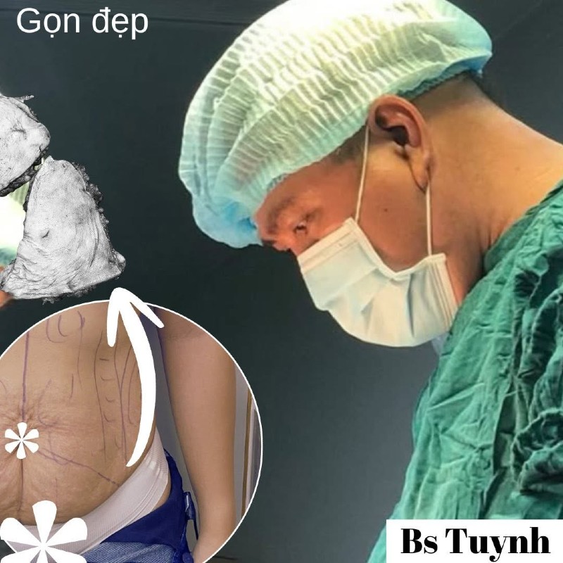 Quy trình phẫu thuật tạo hình thành bụng