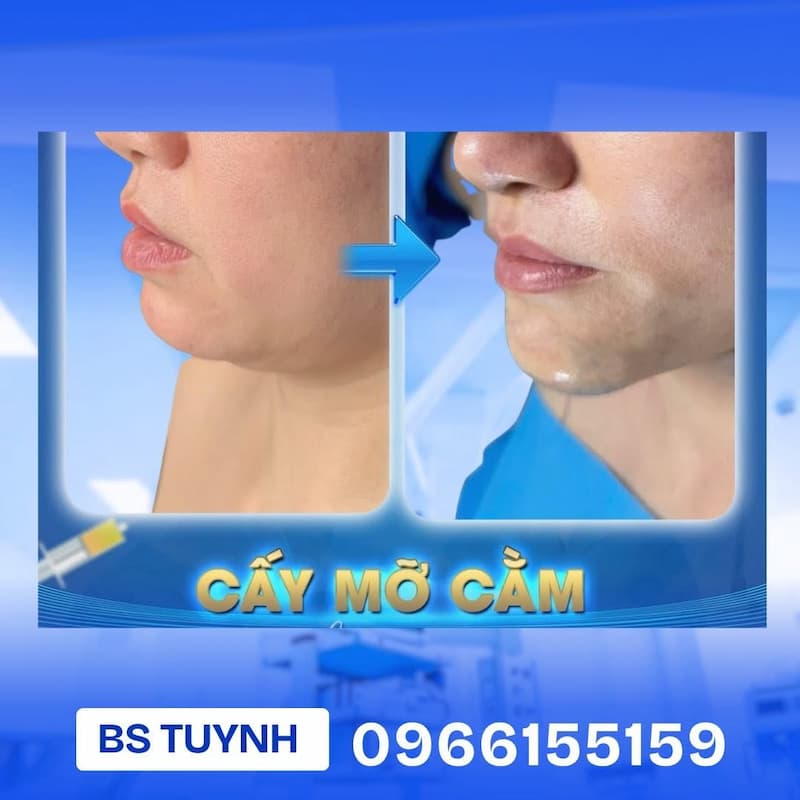 cay mo cam (1)