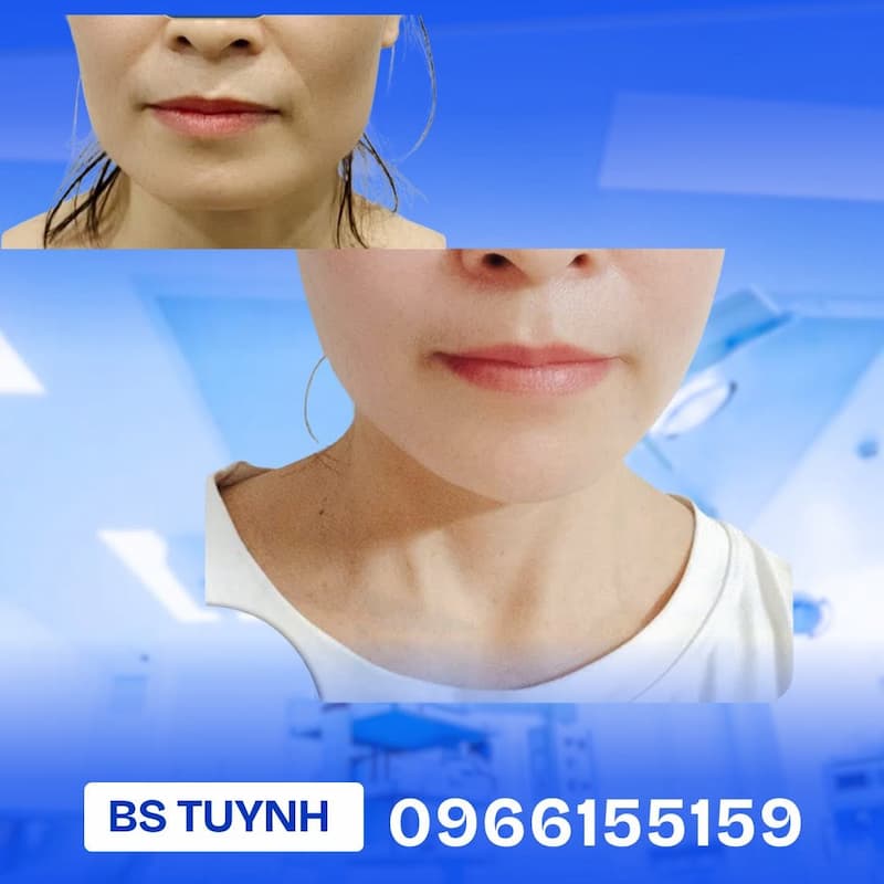 cay mo tu than lam day ranh cuoi