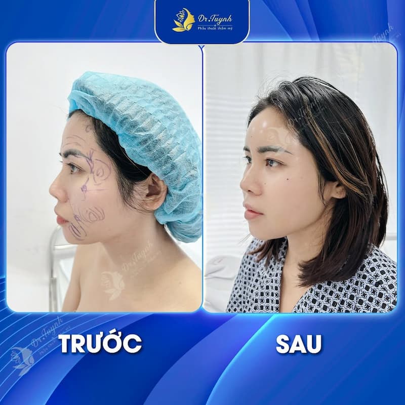 cay mo tu than mat dr tuynh (1)