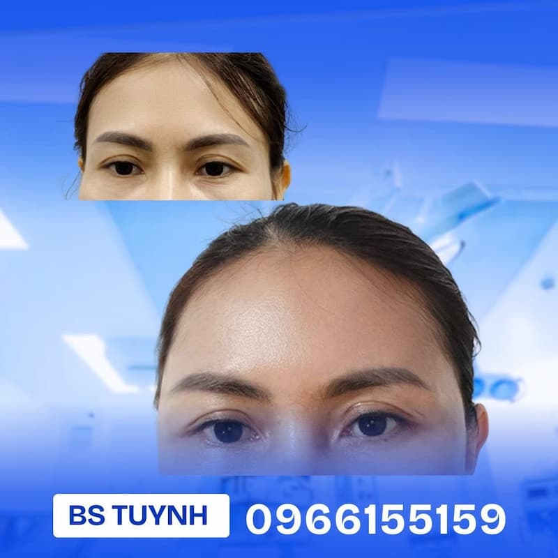 cay mo tu than vung mat