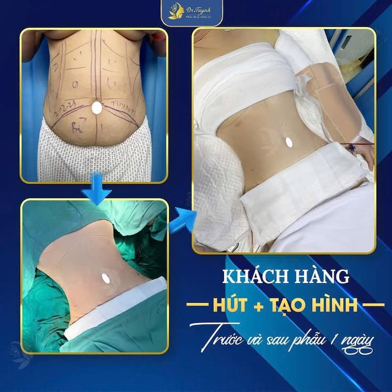 hut mo dr tuynh (1)